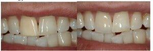 X | Bellingham Dentist | Dental Implants | Northside Dental Care X | Bellingham Dentist | Dental Implants | Northside Dental Care