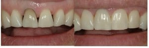X | Bellingham Dentist | Dental Implants | Northside Dental Care X | Bellingham Dentist | Dental Implants | Northside Dental Care