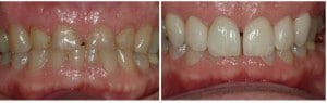 X | Bellingham Dentist | Dental Implants | Northside Dental Care X | Bellingham Dentist | Dental Implants | Northside Dental Care