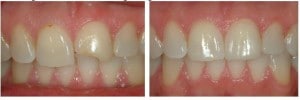 X | Bellingham Dentist | Dental Implants | Northside Dental Care X | Bellingham Dentist | Dental Implants | Northside Dental Care