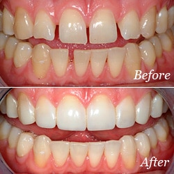 Bonding | Bellingham Dentist | Dental Implants | Northside Dental Care Bonding | Bellingham Dentist | Dental Implants | Northside Dental Care