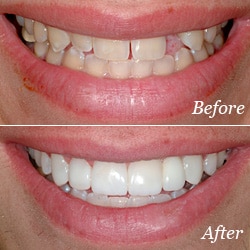 Bridges | Bellingham Dentist | Dental Implants | Northside Dental Care Bridges | Bellingham Dentist | Dental Implants | Northside Dental Care