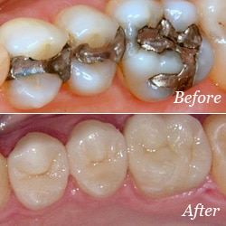 Crowns | Bellingham Dentist | Dental Implants | Northside Dental Care Crowns | Bellingham Dentist | Dental Implants | Northside Dental Care