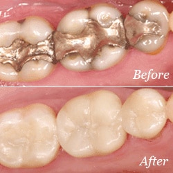 Fillings | Bellingham Dentist | Dental Implants | Northside Dental Care Fillings | Bellingham Dentist | Dental Implants | Northside Dental Care