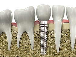 Implant Model | Bellingham Dentist | Dental Implants | Northside Dental Care Implant Model | Bellingham Dentist | Dental Implants | Northside Dental Care