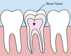 Root Canals | Bellingham Dentist | Dental Implants | Northside Dental Care Root Canals | Bellingham Dentist | Dental Implants | Northside Dental Care