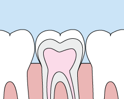 Sealants | Bellingham Dentist | Dental Implants | Northside Dental Care Sealants | Bellingham Dentist | Dental Implants | Northside Dental Care