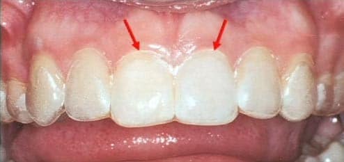 Teeth Whitening | Bellingham Dentist | Dental Implants | Northside Dental Care Teeth Whitening | Bellingham Dentist | Dental Implants | Northside Dental Care