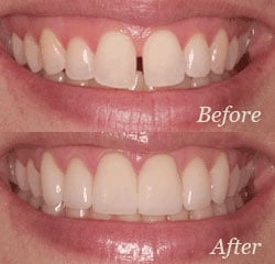 Veneers | Bellingham Dentist | Dental Implants | Northside Dental Care Veneers | Bellingham Dentist | Dental Implants | Northside Dental Care