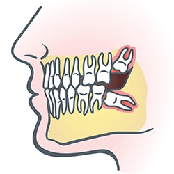 Wisdom Teeth Illus | Bellingham Dentist | Dental Implants | Northside Dental Care Wisdom Teeth Illus | Bellingham Dentist | Dental Implants | Northside Dental Care