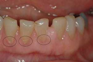 Dscf X | Bellingham Dentist | Dental Implants | Northside Dental Care Dscf X | Bellingham Dentist | Dental Implants | Northside Dental Care