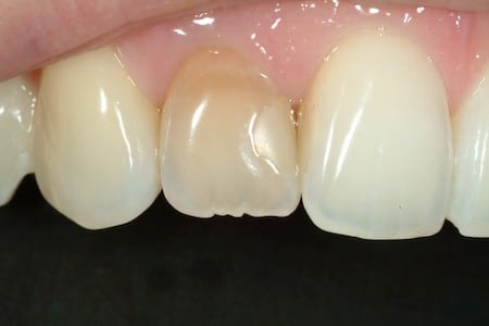 T | Bellingham Dentist | Dental Implants | Northside Dental Care T | Bellingham Dentist | Dental Implants | Northside Dental Care