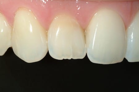T | Bellingham Dentist | Dental Implants | Northside Dental Care T | Bellingham Dentist | Dental Implants | Northside Dental Care