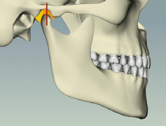 Tmj Tmd Stable Bite | Bellingham Dentist | Dental Implants | Northside Dental Care