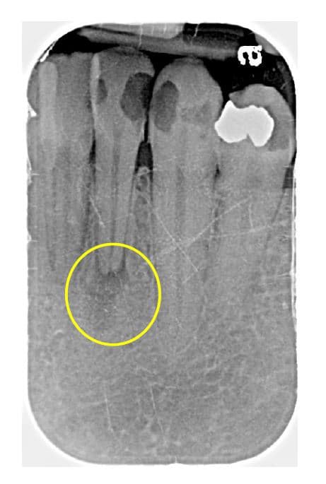 Xray | Bellingham Dentist | Dental Implants | Northside Dental Care