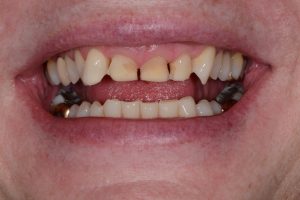 X | Bellingham Dentist | Dental Implants | Northside Dental Care