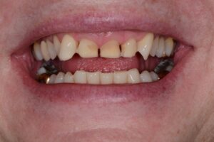 X | Bellingham Dentist | Dental Implants | Northside Dental Care
