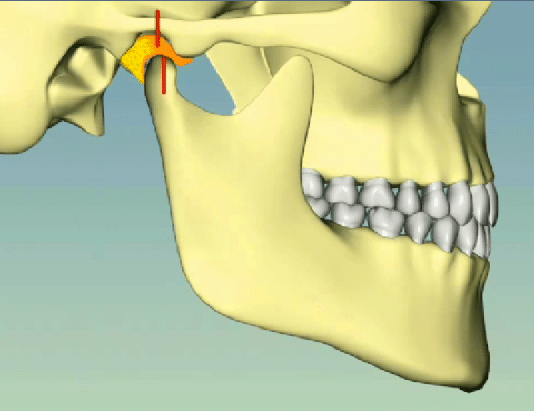 Tmj Tmd Unstable Bite | Bellingham Dentist | Dental Implants | Northside Dental Care