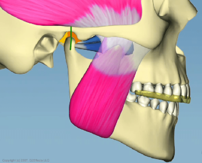 Tpj Tmd Occlusion Splint | Bellingham Dentist | Dental Implants | Northside Dental Care